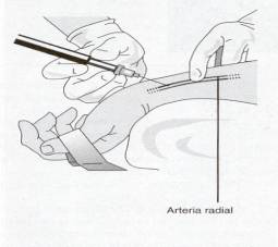 Gasometria Arterial